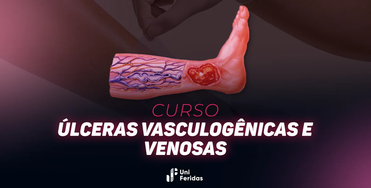 Capa do curso de úlceras vasculogênicas, com modelo anatômico de perna e úlcera